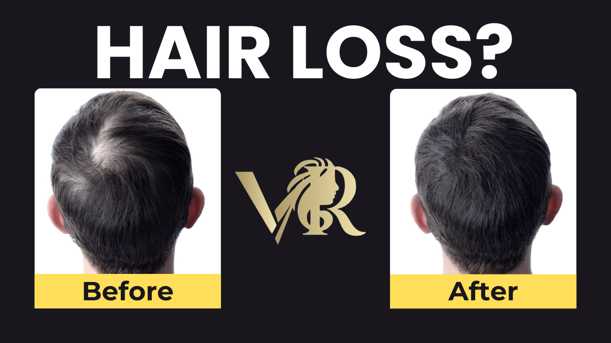 Hair Loss Treatment Clinic Greater Noida