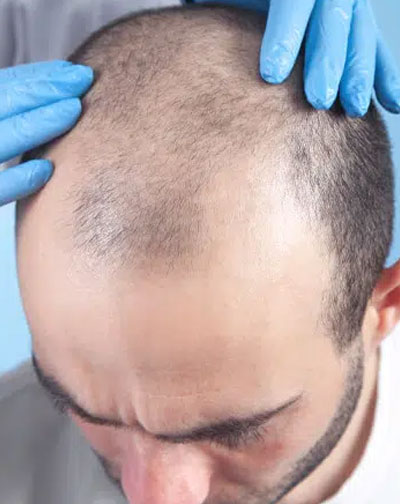 Hair Transplant