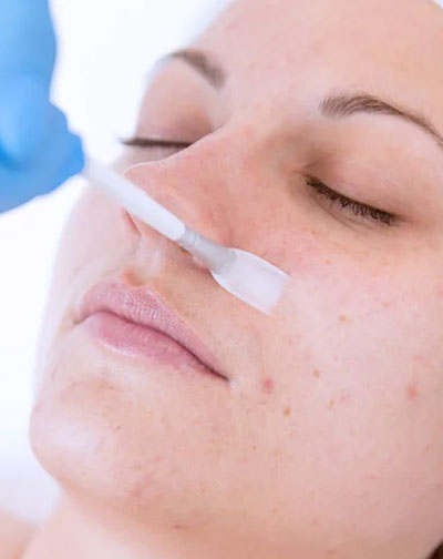 chemical peels