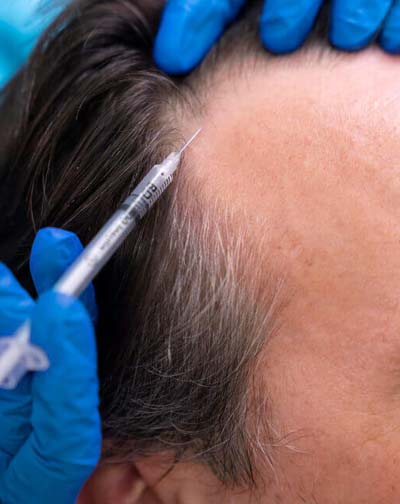 PRP for hair